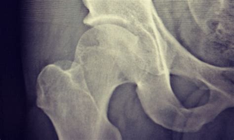 What is Femoral Acetabular Impingement? - FAI Symptoms in Runners