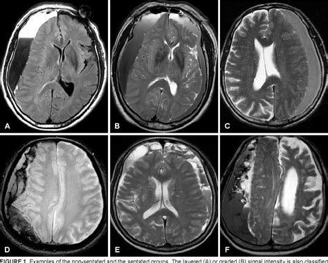 Subdural Hematoma Mri