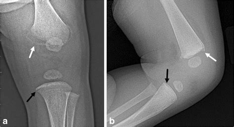 Classic metaphyseal lesion in a 62-day-old girl with bruising who was... | Download Scientific ...