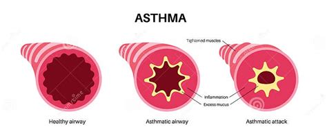 Asthma lung disease stock vector. Illustration of respiratory - 272815165