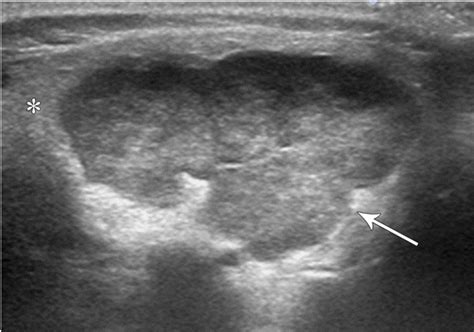 Parotid Gland Parotitis