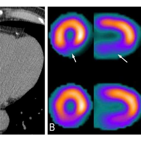 Patient with calcium score 11-100. (A) Discreet quantity of calcified... | Download Scientific ...