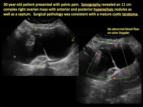 Cystic Teratoma Ultrasound