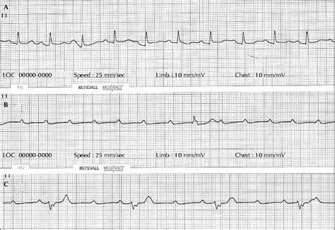 John Libbey Eurotext - Epileptic Disorders - Unrecognized paroxysmal ventricular standstill ...