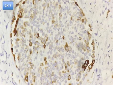 07 histology, cytology and biomarkers in pleural diseases | PPT