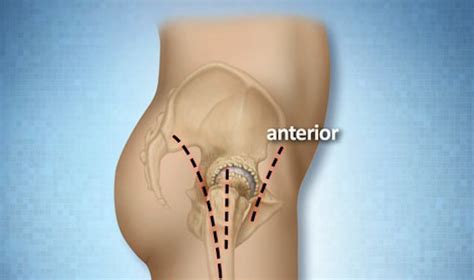 Hip replacement anterior vs posterior approach | doctorvisit