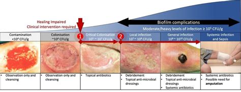 The wound infection continuum. Wound infections develop and progress as... | Download Scientific ...