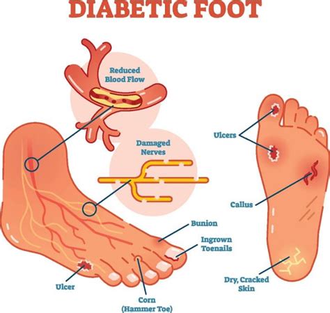 Diabetic Foot | Treatment for Diabetic Neuropathy