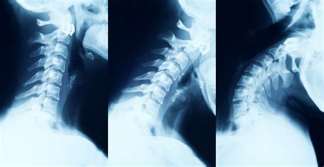 Cervical Instability - Causes & Best Treatment Options in 2023