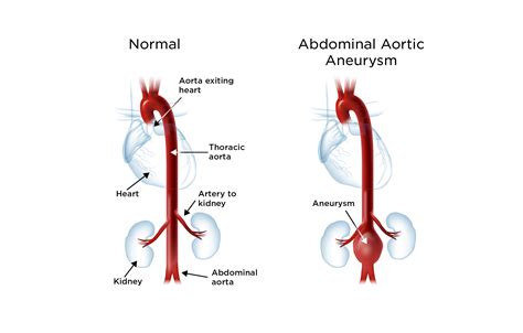 Aortic Aneurysm | My Doctor Online