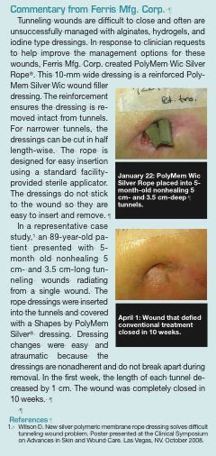 Pearls for Practice: Wound Tunneling