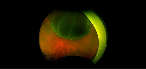 California - Retinal Detachment, RG