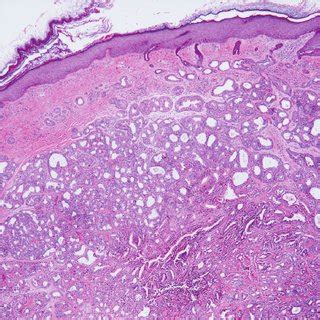 (PDF) Ceruminous adenomas: a clinicopathologic study of 41 cases with a review of the literature