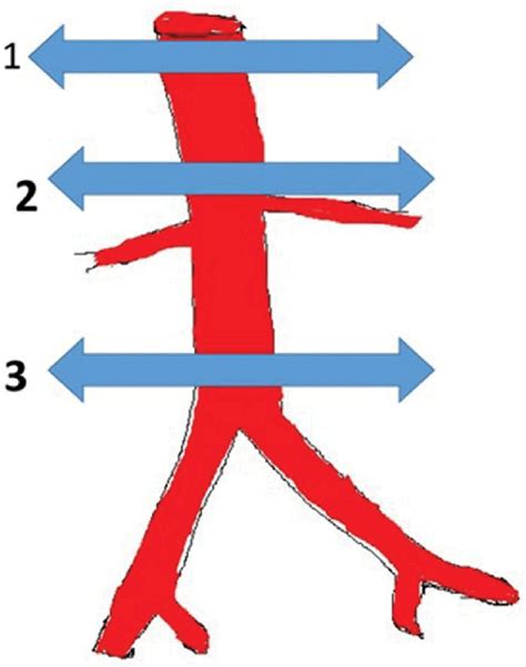 Aortic levels: 1: Hiatus level; 2: Suprarenal level; 3: Bifurcation level. | Download Scientific ...