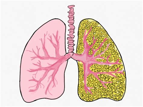 Popcorn Lung: Health Risks and Other Side Effects Surrounding Vaping ...