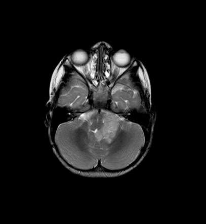 Ependymoma | Radiology Case | Radiopaedia.org