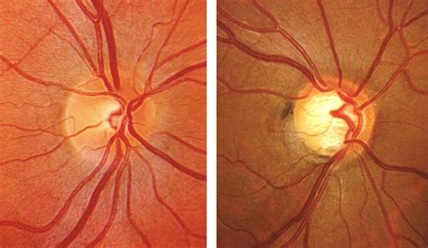 Glaucoma Treatment | Olson Optical | Optometrist in Saint James, MN