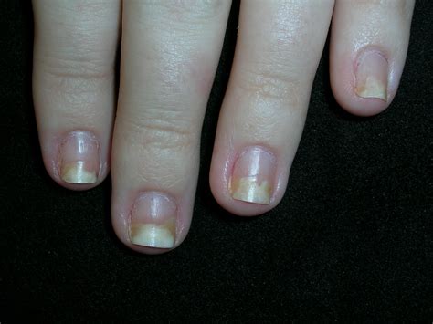 Abnormal fingernails | MDedge Family Medicine