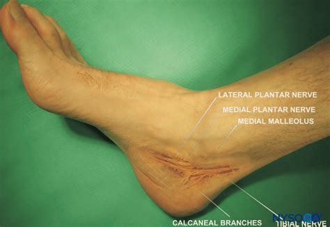 Lateral Plantar Nerve Block