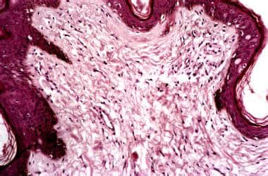 Acrochordon Histology