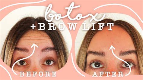 Getting Botox + Brow Lift! * Before & After (VLOG) - YouTube