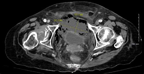 Cureus | Acute Perforated Appendicitis Complicated by Necrotizing ...