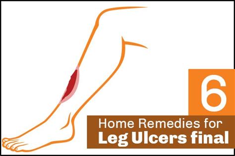 6 Effective Home Remedies For Leg Ulcers | Leg ulcers, Feet care, Ulcers