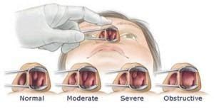 Nasal Obstruction and Nasal Congestion Treatment In West Hills, L.A ...