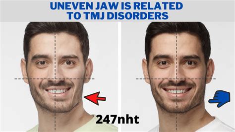 Uneven Jaw is related to TMJ disorders - How do you fix TMJ uneven jaw? | 247nht - YouTube