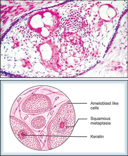 Globulomaxillary Cyst Histology