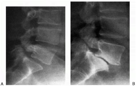 Progression and Surgical Management of Isthmic Spondylolisthesis in ...