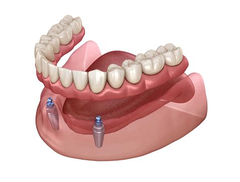 How Dental Implants Secure Your Dentures