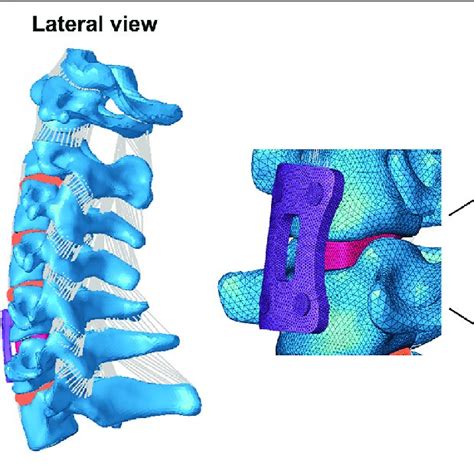 | FE model of single-level C5/6 ACDF implanted with a cage plus plate... | Download Scientific ...