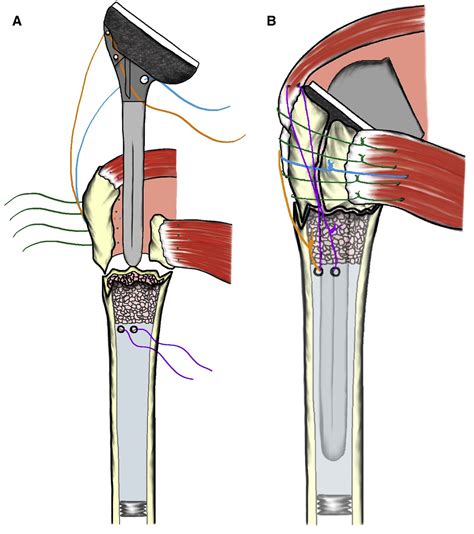 Tuberosity healing after reverse shoulder arthroplasty for acute proximal humerus fractures: the ...