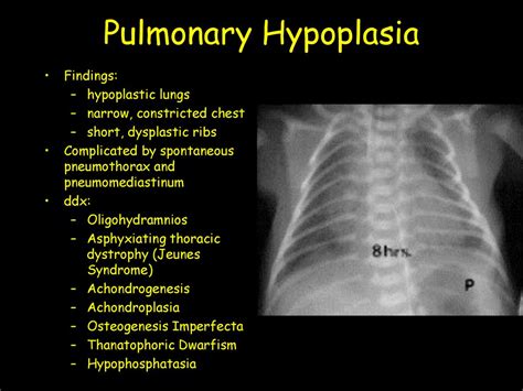 Pulmonary Hypoplasia In Newborn