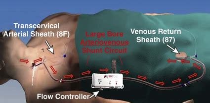 Embolic Protection Devices | Radiology Key