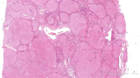 Liver Cirrhosis Pathology