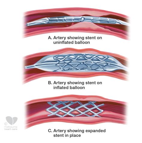 Coronary Stent - Melbourne Heart Care