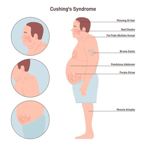 Is Cushing Syndrome Fatal? Find Out More...