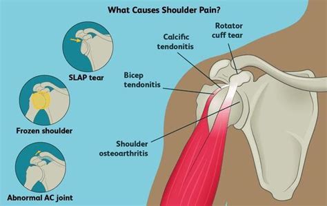 Shoulder Bone Spurs and Impingement Syndrome: Louis Peter Re, Jr., MD