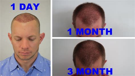 36+ 3 Month Hair Transplant Month By Month - JasmanRaigan