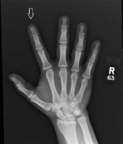 Distal Phalanx Fracture