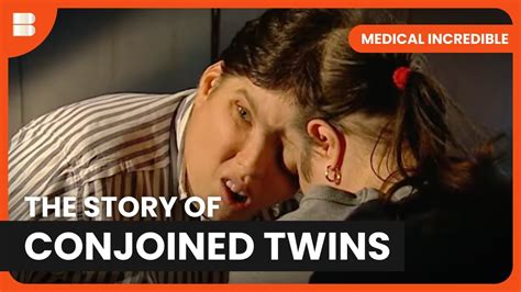 Living as a Conjoined Twin - Medical Incredible - Documentary - YouTube