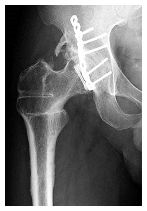 Case 1. (a) Anteroposterior X-ray image of the right hip at 3 years ...