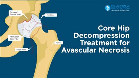 Core Hip Decompression Treatment for Avascular Necrosis | A/Professor Andrew Dutton