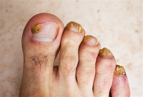 Foot Fungus Remedies – Foot Care Tips