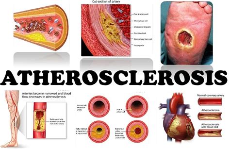 Atherosclerosis - Cause, Symptoms, Treatment - Samarpan Physio