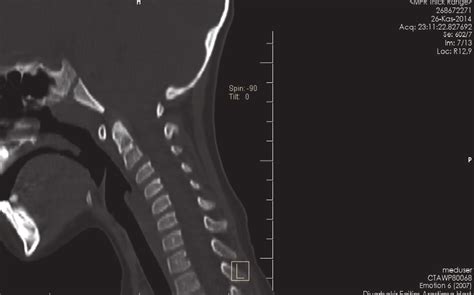 The transverse clivus fracture line along the craniocervical line; CT ...