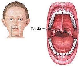 Home Remedies for Tonsils in Children - Natural Treatments