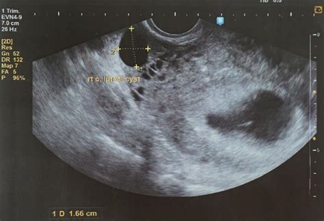 5 Weeks Pregnanct Ultrasound: Procedure, Abnormalities and more